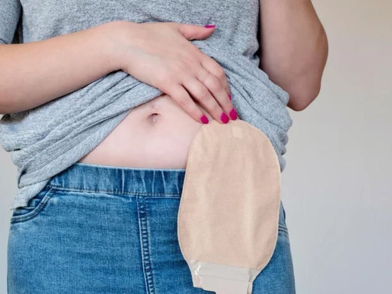 Encontro do Grupo de Apoio à Pessoa Ostomizada acontece no dia 10 de novembro